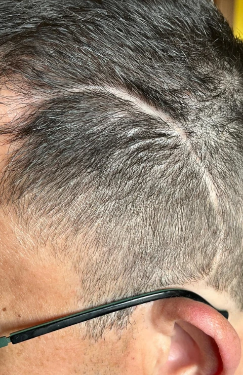 como esconder una cicatriz 1