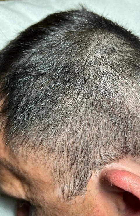 como esconder una cicatriz 2